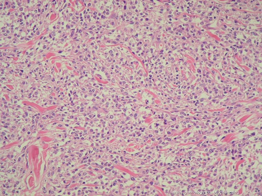 皮肤肿物（会1382）-组织细胞肉瘤图7
