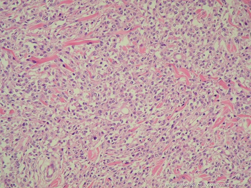皮肤肿物（会1382）-组织细胞肉瘤图8