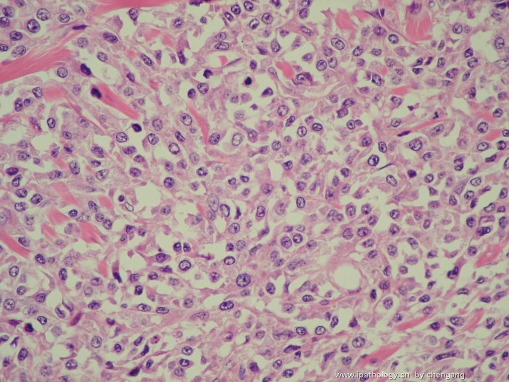 皮肤肿物（会1382）-组织细胞肉瘤图9