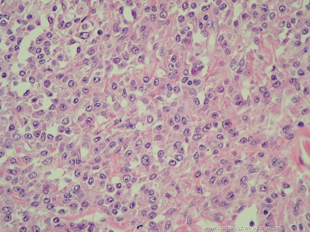 皮肤肿物（会1382）-组织细胞肉瘤图10