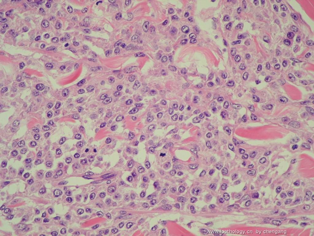 皮肤肿物（会1382）-组织细胞肉瘤图11