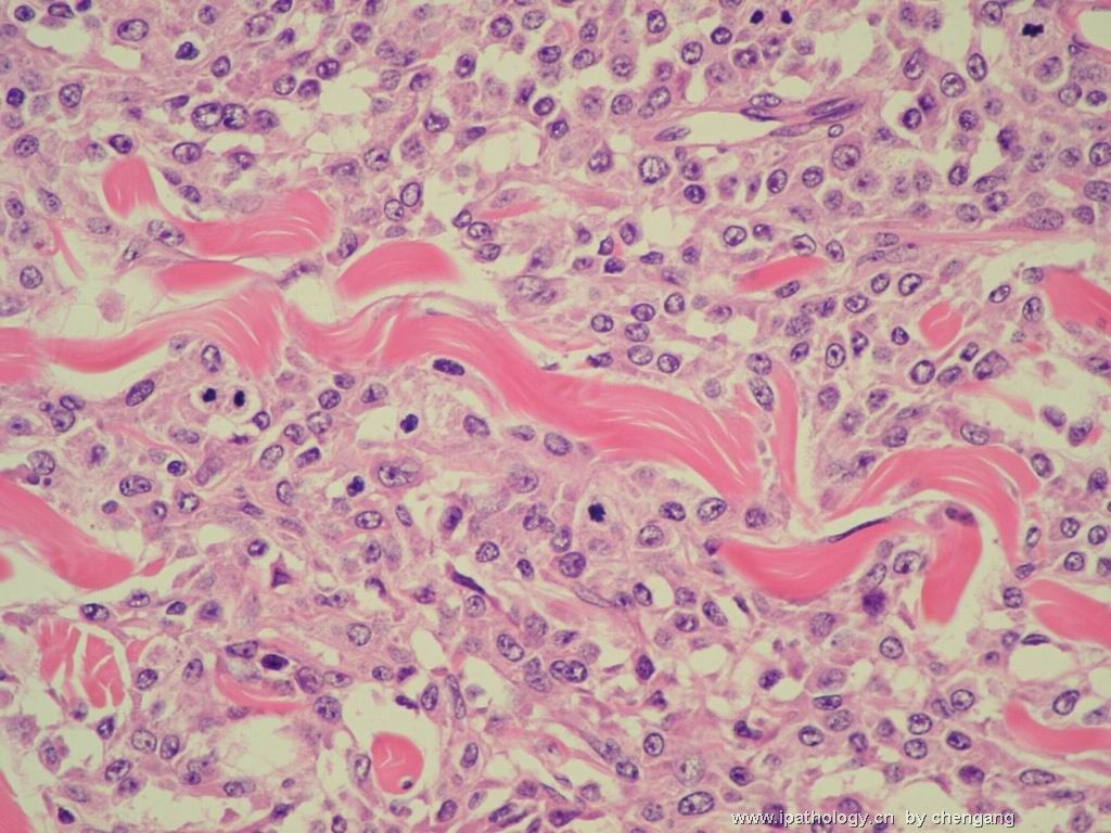 皮肤肿物（会1382）-组织细胞肉瘤图12