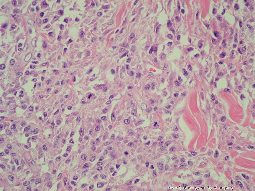 皮肤肿物（会1382）-组织细胞肉瘤图13