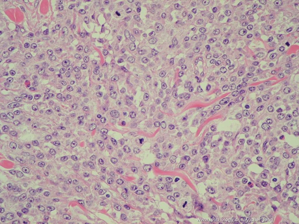 皮肤肿物（会1382）-组织细胞肉瘤图14