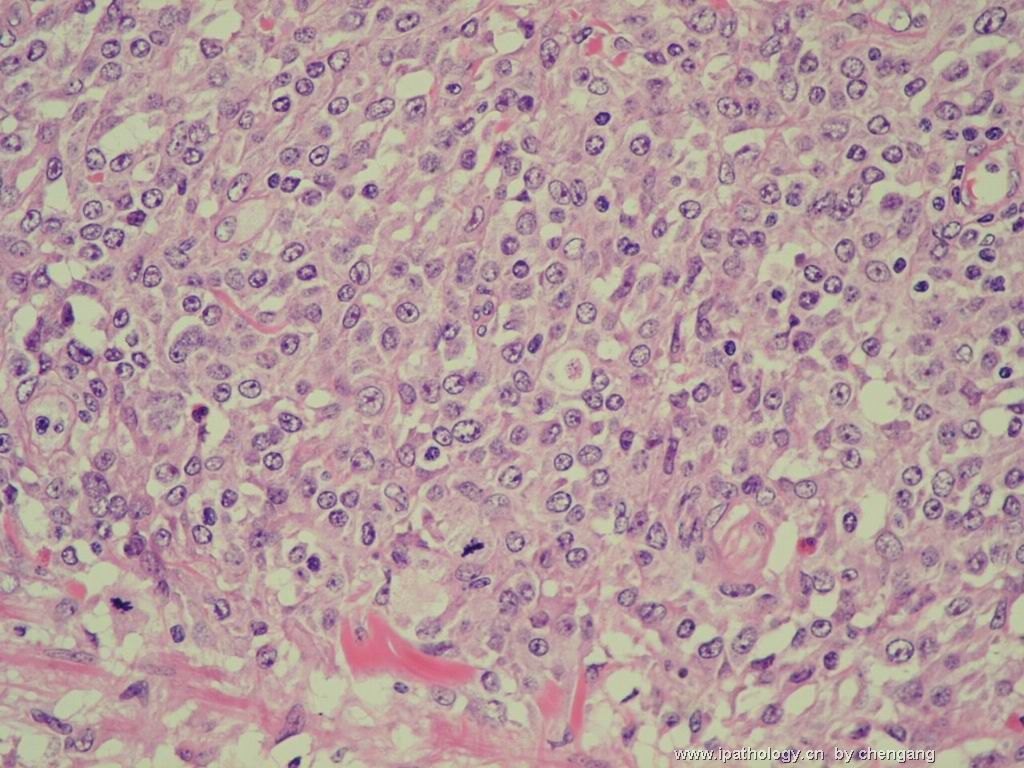 皮肤肿物（会1382）-组织细胞肉瘤图15