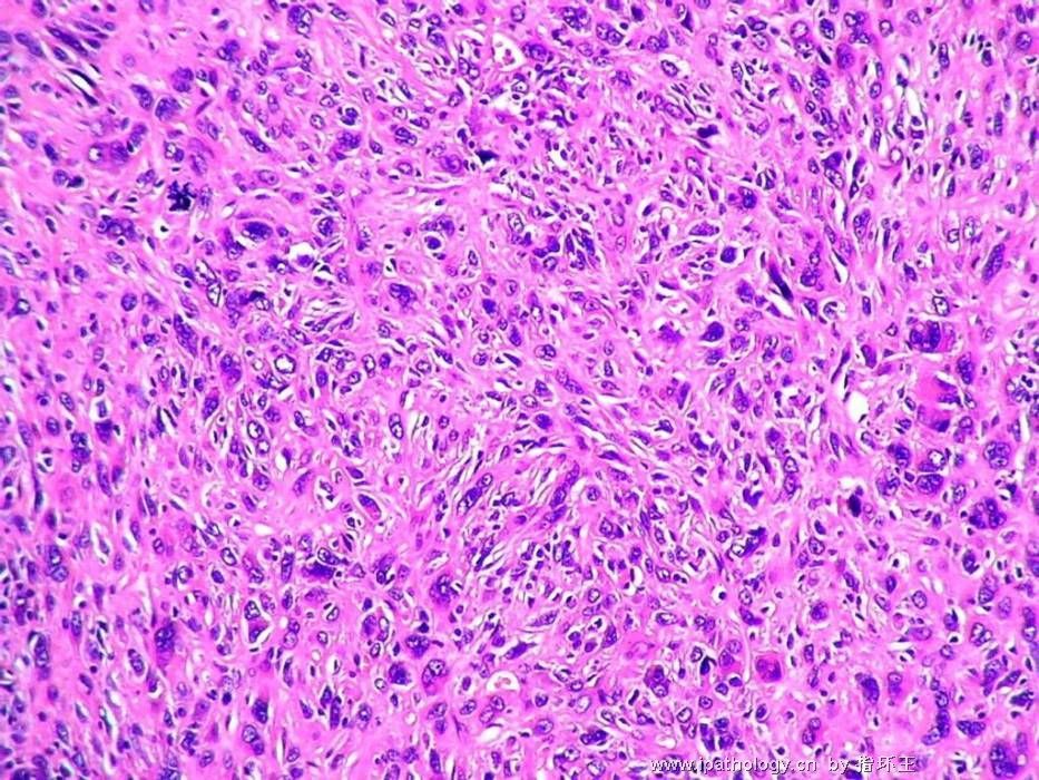 膀胱肿瘤—血管肉瘤图2