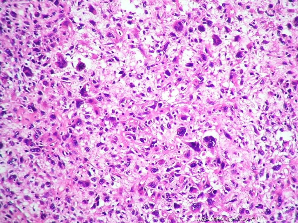 膀胱肿瘤—血管肉瘤图3