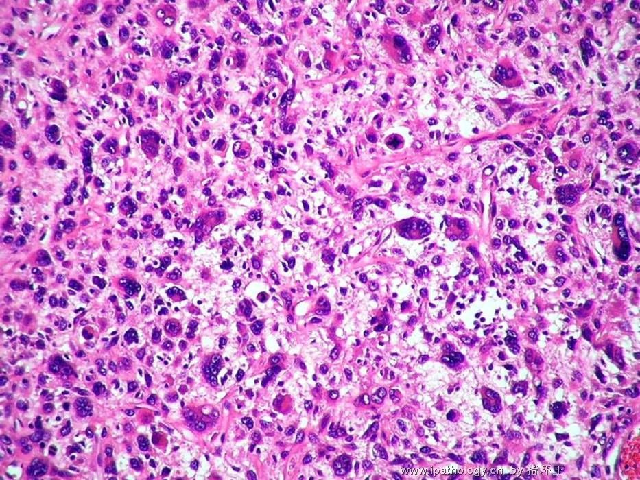膀胱肿瘤—血管肉瘤图4