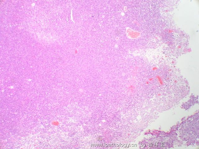 膀胱肿瘤—浆细胞型尿路上皮癌图1