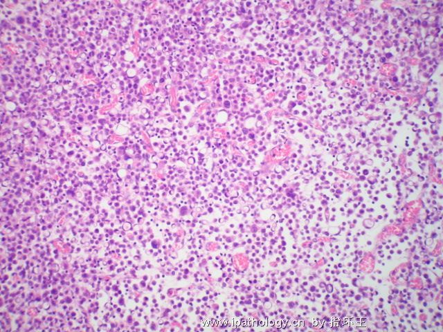 膀胱肿瘤—浆细胞型尿路上皮癌图2