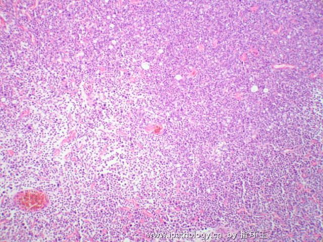 膀胱肿瘤—浆细胞型尿路上皮癌图3