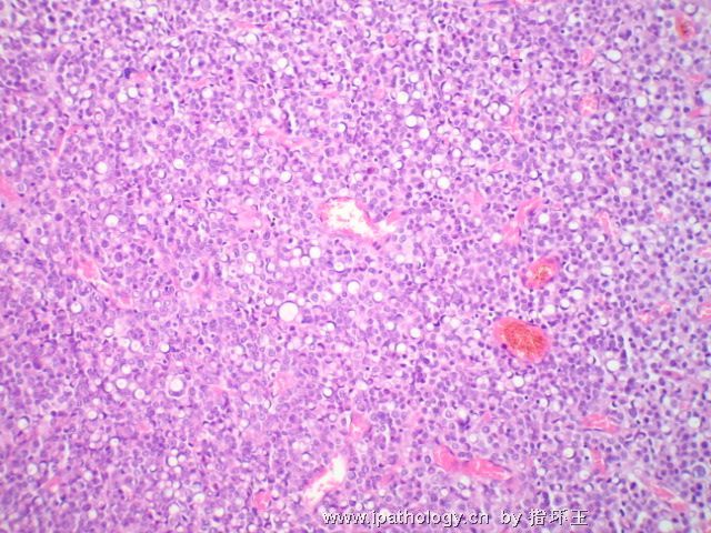 膀胱肿瘤—浆细胞型尿路上皮癌图4