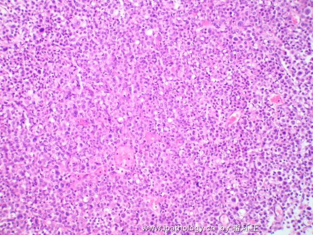 膀胱肿瘤—浆细胞型尿路上皮癌图5