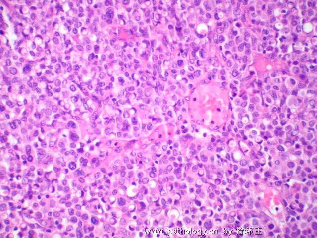 膀胱肿瘤—浆细胞型尿路上皮癌图6