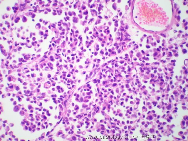 膀胱肿瘤—浆细胞型尿路上皮癌图7