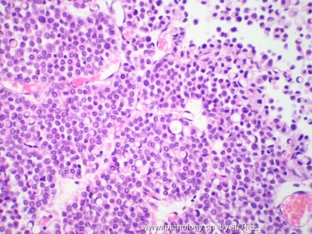 膀胱肿瘤—浆细胞型尿路上皮癌图8