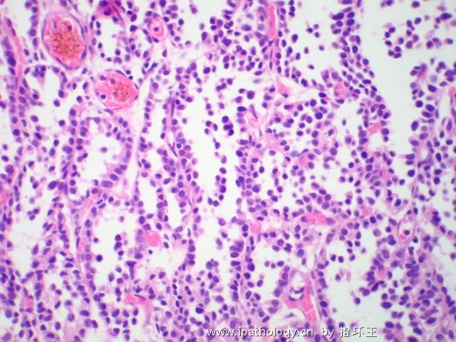 膀胱肿瘤—浆细胞型尿路上皮癌图9