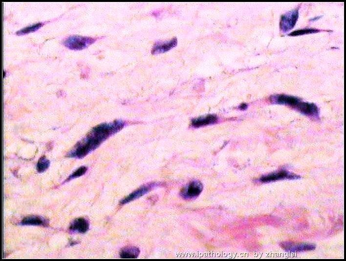 眉间肿块（巨细胞性纤维母细胞瘤）图11