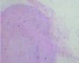乳腺多发肿瘤，重发图片图1