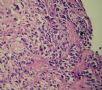 胃镜活检--胃黏液腺癌图7