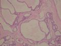 female53y胰腺占位--胰腺浆液性微囊性腺瘤图1