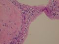 female53y胰腺占位--胰腺浆液性微囊性腺瘤图2