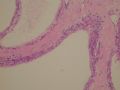female53y胰腺占位--胰腺浆液性微囊性腺瘤图3