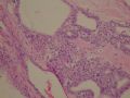 female53y胰腺占位--胰腺浆液性微囊性腺瘤图4