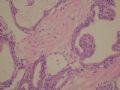 female53y胰腺占位--胰腺浆液性微囊性腺瘤图5