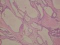 female53y胰腺占位--胰腺浆液性微囊性腺瘤图6