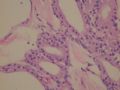 female53y胰腺占位--胰腺浆液性微囊性腺瘤图7