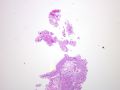 膀胱病变-1-papillary nephrogenic adenoma (乳头状肾源性腺瘤)图1