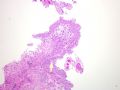 膀胱病变-1-papillary nephrogenic adenoma (乳头状肾源性腺瘤)图2