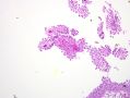 膀胱病变-1-papillary nephrogenic adenoma (乳头状肾源性腺瘤)图3