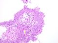 膀胱病变-1-papillary nephrogenic adenoma (乳头状肾源性腺瘤)图4
