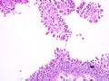 膀胱病变-1-papillary nephrogenic adenoma (乳头状肾源性腺瘤)图5
