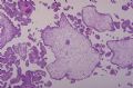 滋养细胞疾病——葡萄胎图4