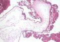 滋养细胞疾病——葡萄胎图6