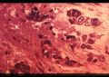 滋养细胞疾病－－绒毛膜上皮癌图2