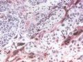 滋养细胞疾病－－绒毛膜上皮癌图3