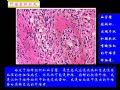 病理学2--第一章 细胞和组织的适应与损伤（2）图22