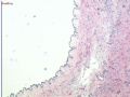 子宫浆膜结节囊肿病变图2