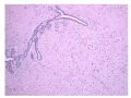 少见病例——乳腺组织细胞-肌母细胞样癌图1