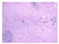 少见病例——乳腺组织细胞-肌母细胞样癌图2