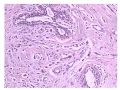 少见病例——乳腺组织细胞-肌母细胞样癌图3