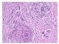 少见病例——乳腺组织细胞-肌母细胞样癌图4
