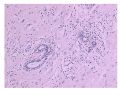 少见病例——乳腺组织细胞-肌母细胞样癌图5