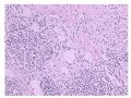 少见病例——乳腺组织细胞-肌母细胞样癌图6