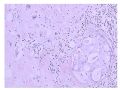 少见病例——乳腺组织细胞-肌母细胞样癌图7