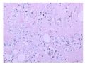 少见病例——乳腺组织细胞-肌母细胞样癌图8